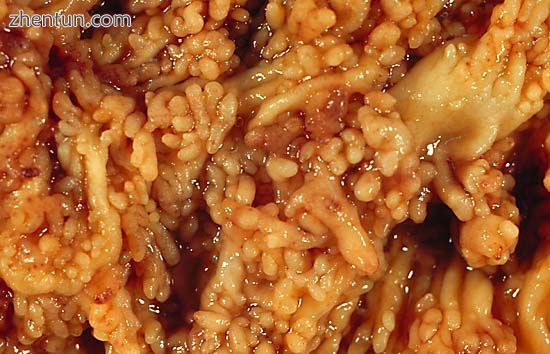 Colonic pseudopolyps of a patient with intractable ulcerative colitis. Colectomy specimen.