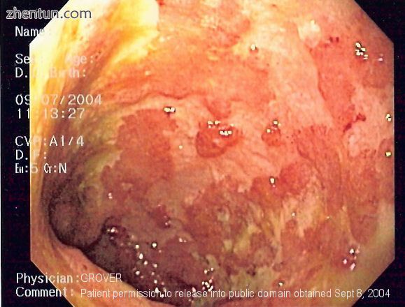 Endoscopic image of ulcerative colitis affecting the left side of the colon. The image shows conflue ...