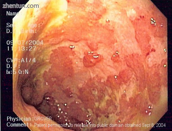 Endoscopic image of ulcerative colitis affecting the left side of the colon. The image shows conflue ...