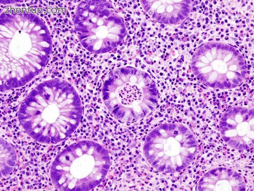 H&E stain of a colonic biopsy showing a crypt abscess, a classic finding in ulcerative colitis