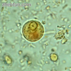 Immature E. histolytica/E. dispar cyst in a concentrated wet mount stained with iodine. This early c ...