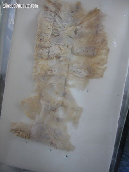 Specimen of the human intestine that was damaged by amebic ulcer.