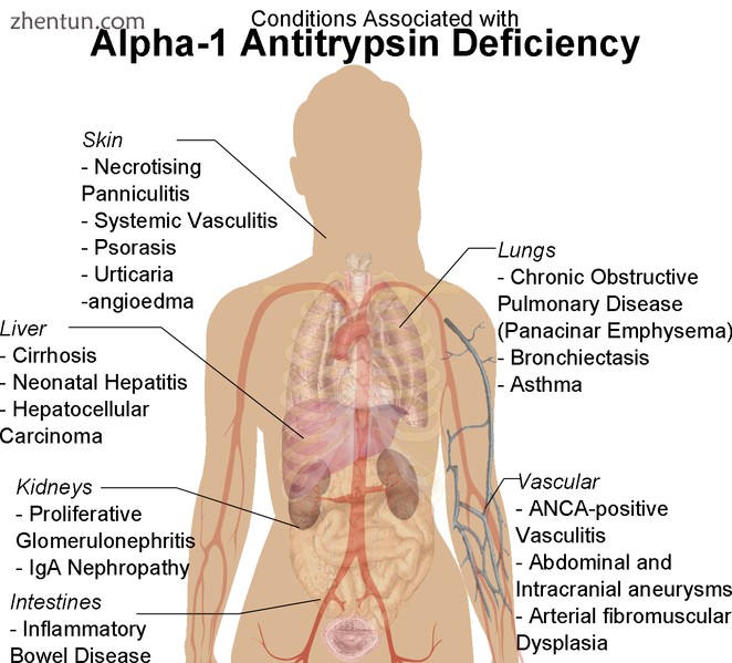 Conditions associated with Alpha-1 Antitrypsin Deficiency, occurring due to paucity of AAT in circul ...