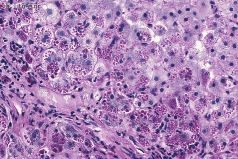 Photomicrograph of a liver biopsy from a patient with alpha-1 antitrypsin deficiency. The PAS with d ...