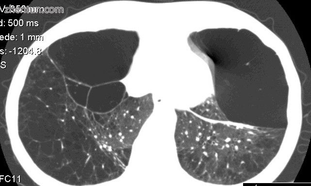 Computed tomography of the lung showing emphysema and bullae in the lower lung l.jpeg