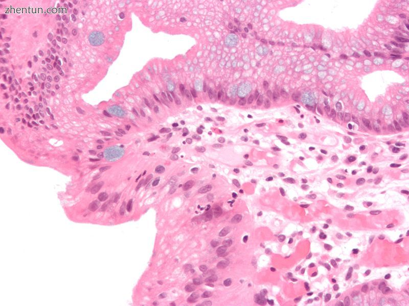 High-magnification micrograph of Barrett's esophagus showing the characteristic goblet cells, Alcian ...