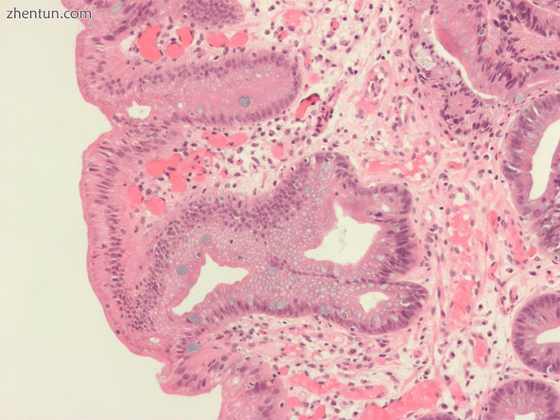 Micrograph of Barrett's esophagus, Alcian blue stain