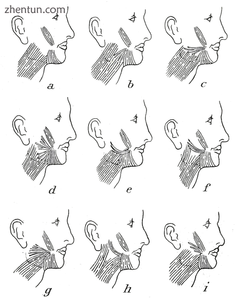 Variations of the risorius, triangularis and zygomaticus muscles.