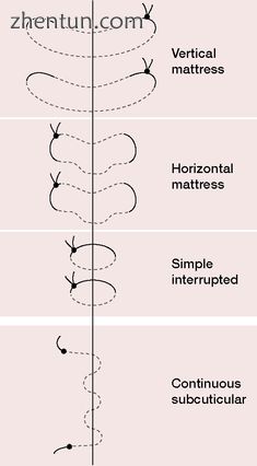 Figure 1  Examples of suture techniques. This article was published in Neale&#03.jpg