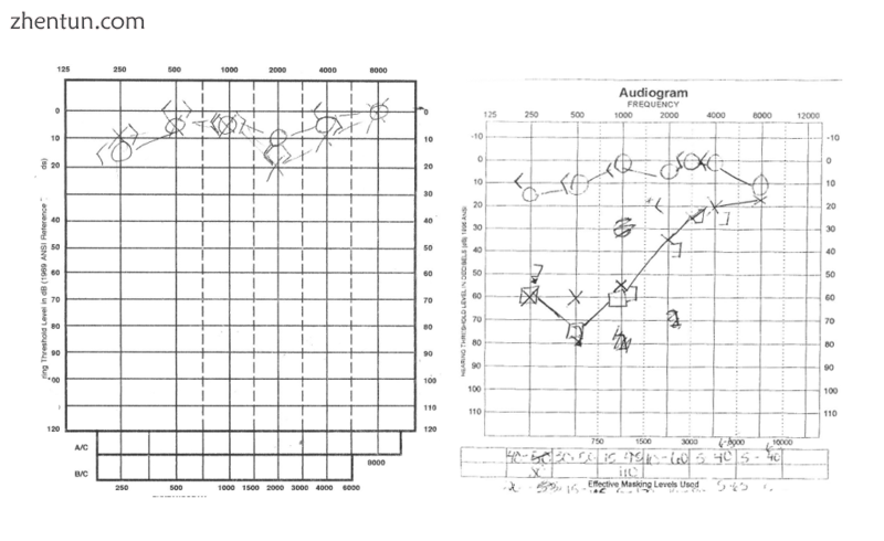 Audiograms illustrating normal hearing (left) and unilateral low-pitch hearing loss associated with  ...