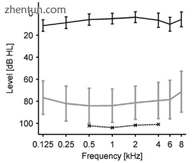 Loudness discomfort levels (LDLs): data of people with hyperacusis without hearing loss. Upper line: ...