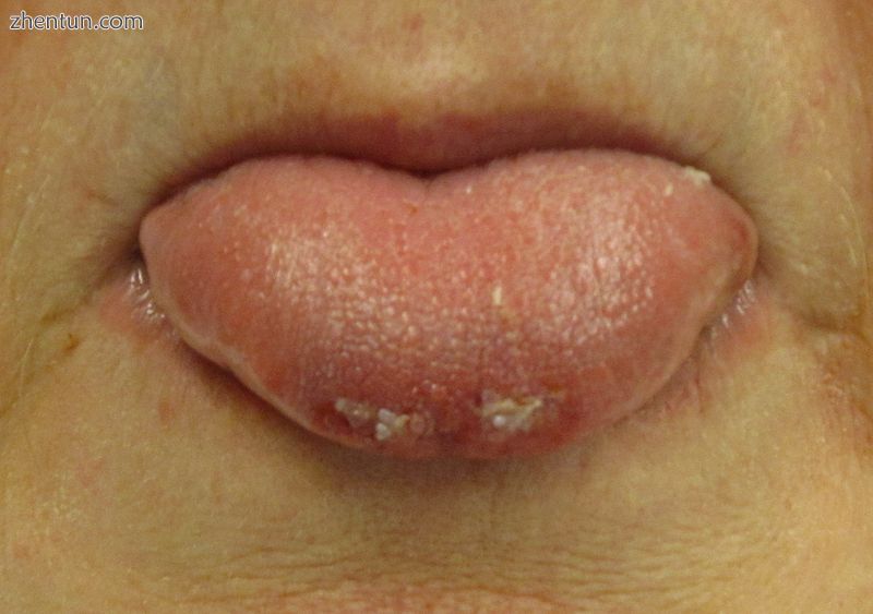A bite to the tip of the tongue due to a seizure.JPG