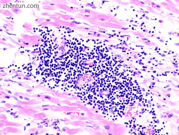 A microscope image of myocarditis at autopsy in a person with acute onset of hea.jpg