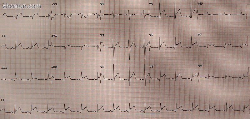 Diffuse ST elevation in a young male due to myocarditis and pericarditis.jpg