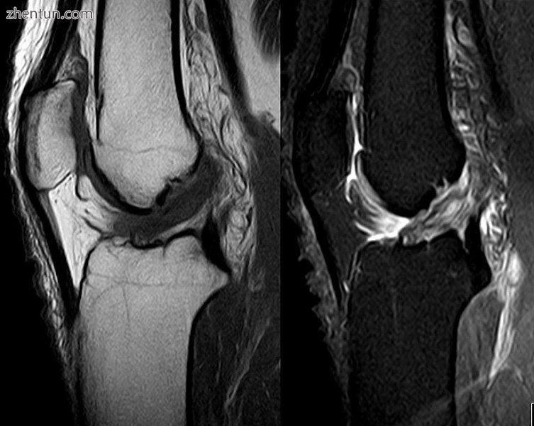 Anterior cruciate ligament tear seen on MRI. T1 left, right PDW..jpg