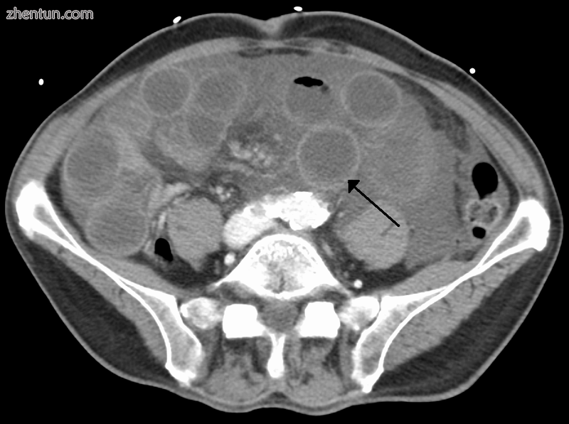 Computer tomography (CT) showing dilated loops of small bowel with thickened wal.png