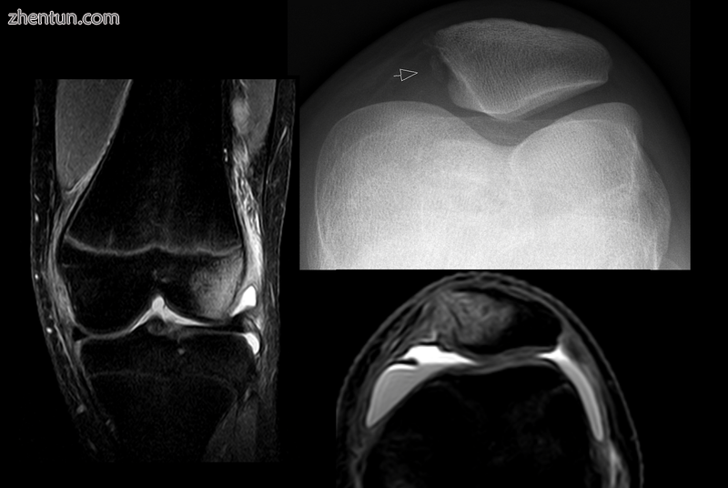 X-ray and MRI after luxation of the patella. There is a fragment and bone bruise.png