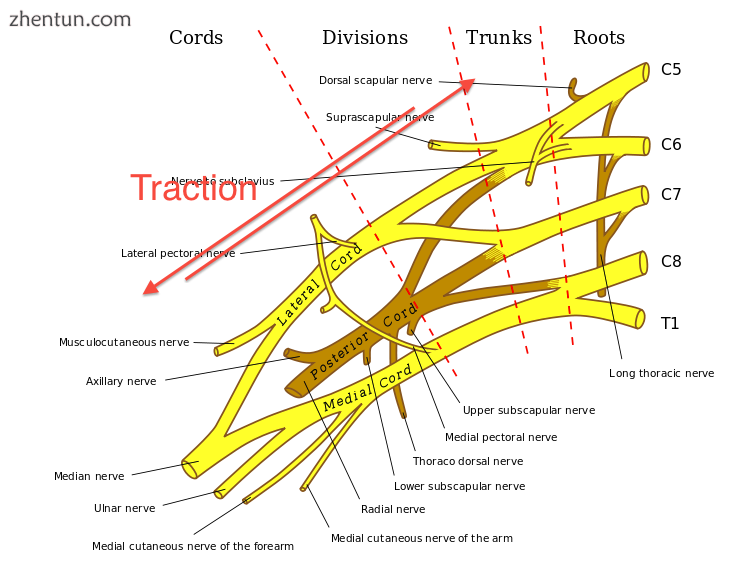 Traction, also known as stretch injury, is one of the mechanisms that cause brachial.png