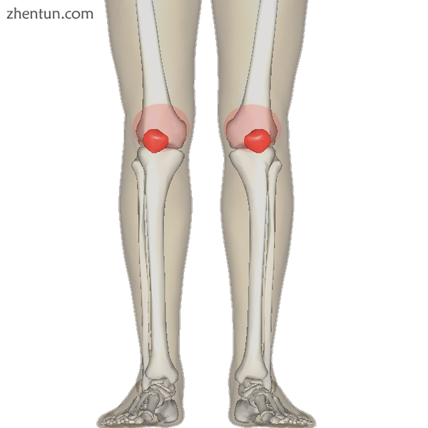 Diagram of the bones of the lower extremity. Rough distribution of areas affecte.png