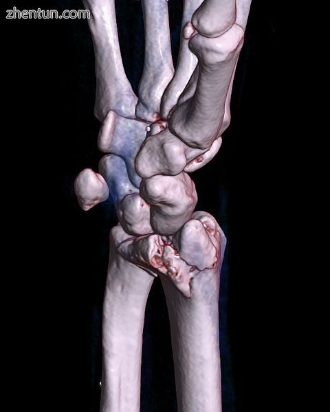 A palmar Barton's fracture of the right wrist, as shown on a 3D-rendered CT scan.jpg