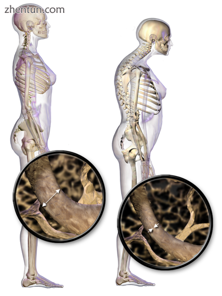 Juvenile osteoporosis.png