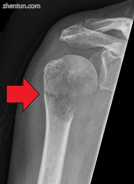 Pathological fracture of the humerus in a patient with metastasis of renal cell .jpg