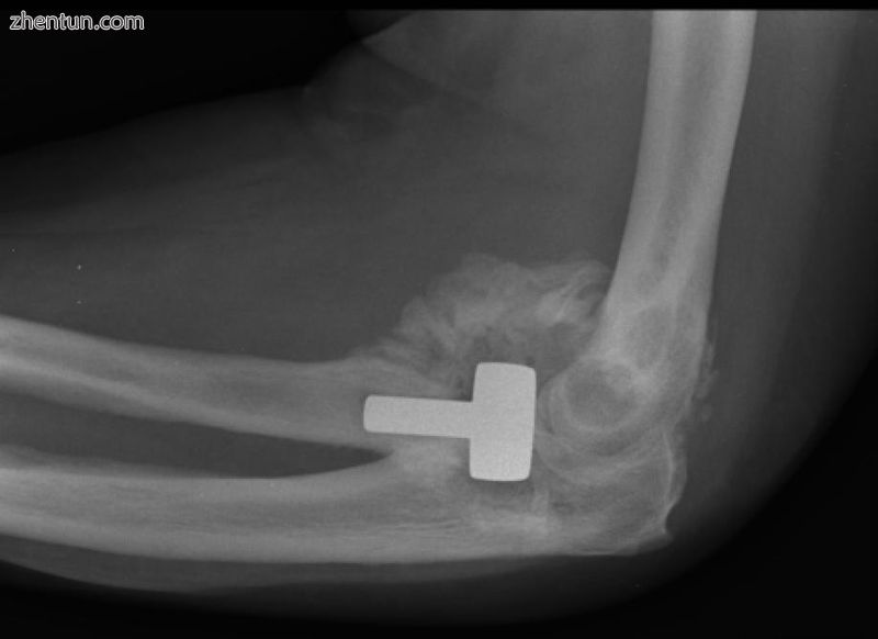 Fibrodysplasia ossificans progressiva.JPG