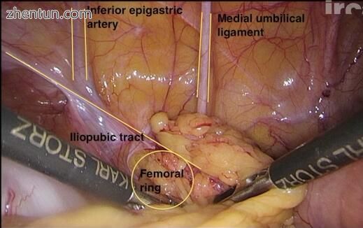 腹腔镜修复不可缩减的股疝.jpg