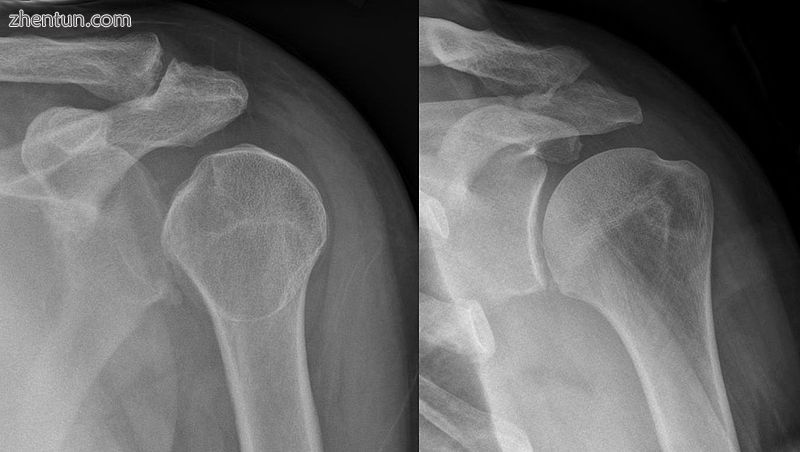 Lightbulb sign indicative of posterior shoulder dislocation shown on the left. O.jpg