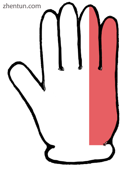 Cartoon depiction of classic ulnar sensory distribution, including mid-4th and 5.png