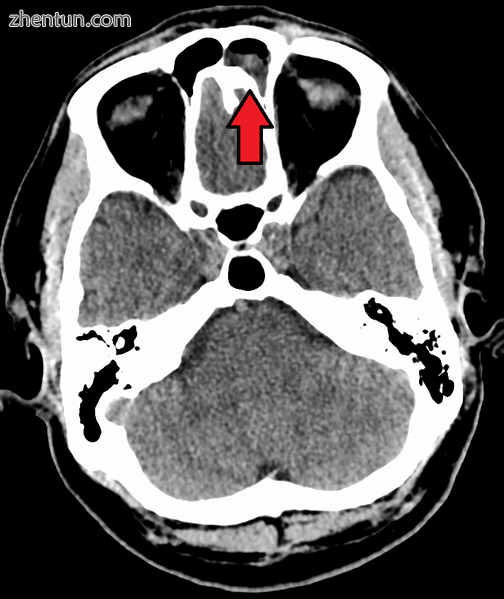 Frontal sinusitis.png