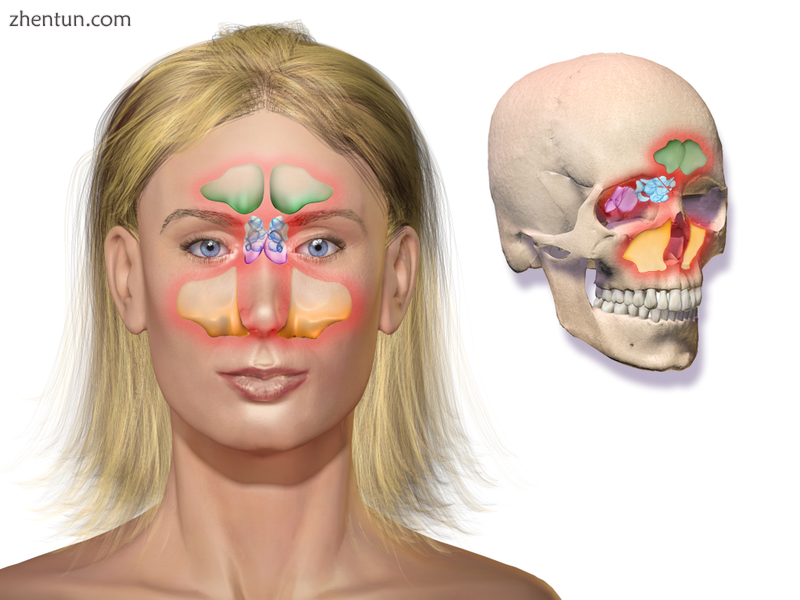 Illustration depicting sinusitis.png