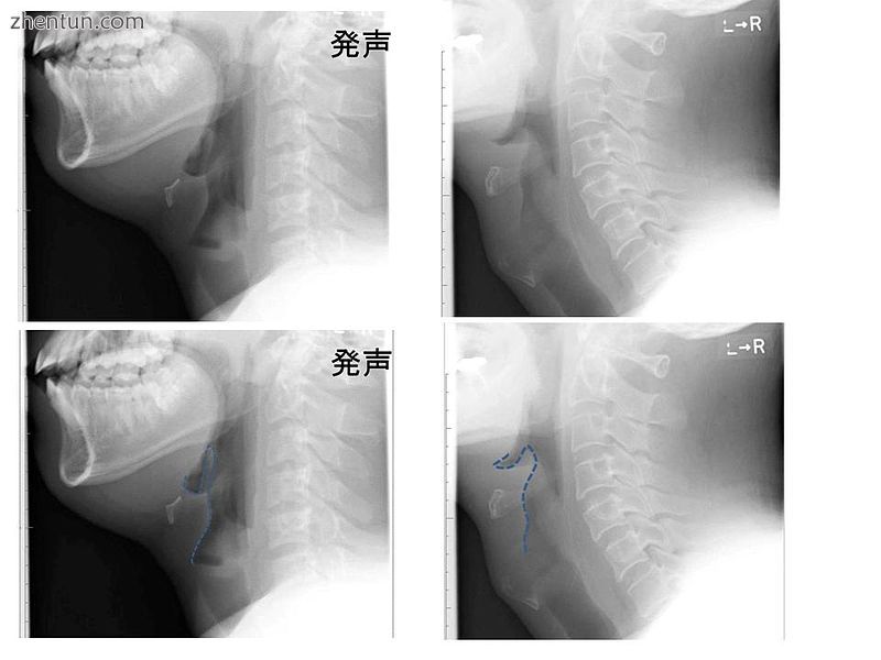 Left column  Normal epiglottis. Right column Epiglottitis..jpg