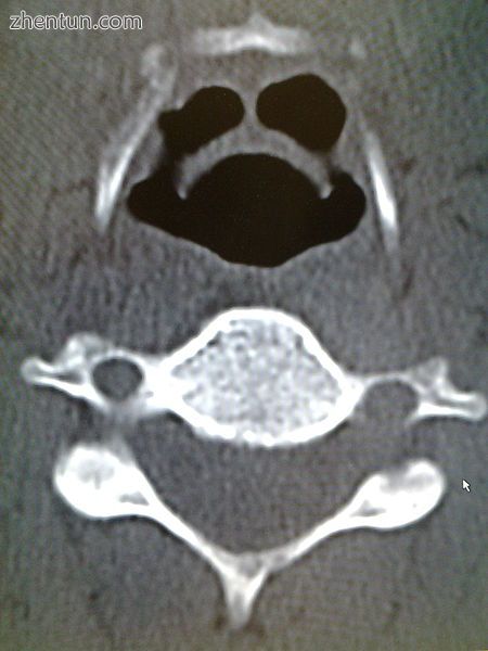 CT imaging showing the  halloween sign.jpg