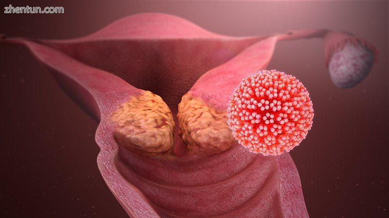 Cervical cancer caused by HPV..jpg