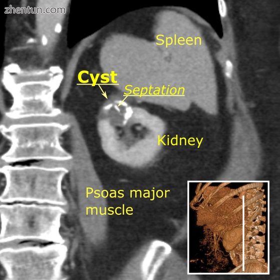 A Bosniak category IIF cyst. This one is 3 cm wide, with calcifications within i.jpg