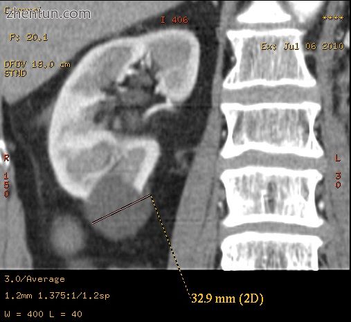 A simple renal cyst..jpg