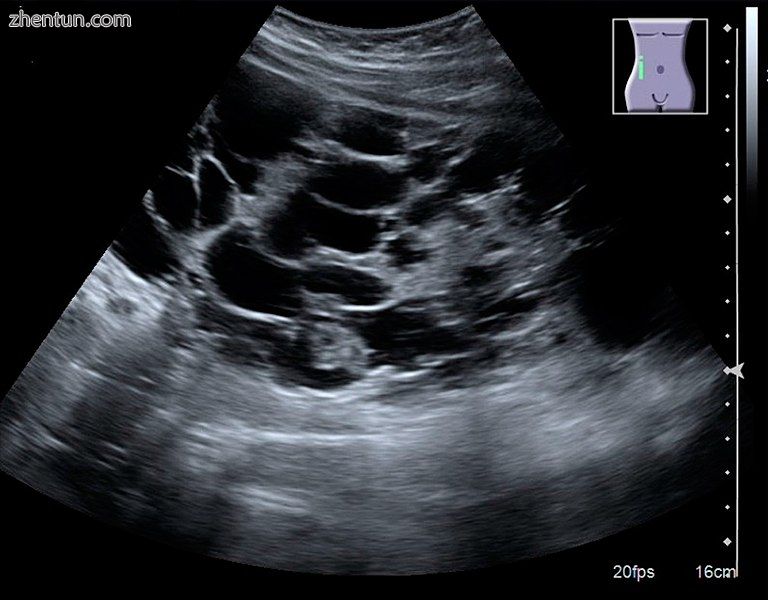 Advanced polycystic kidney disease with multiple cysts.[8].jpg