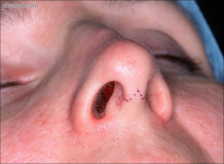Photograph 1. Open rhinoplasty The columellar incision delineated as a red-dot g.jpg