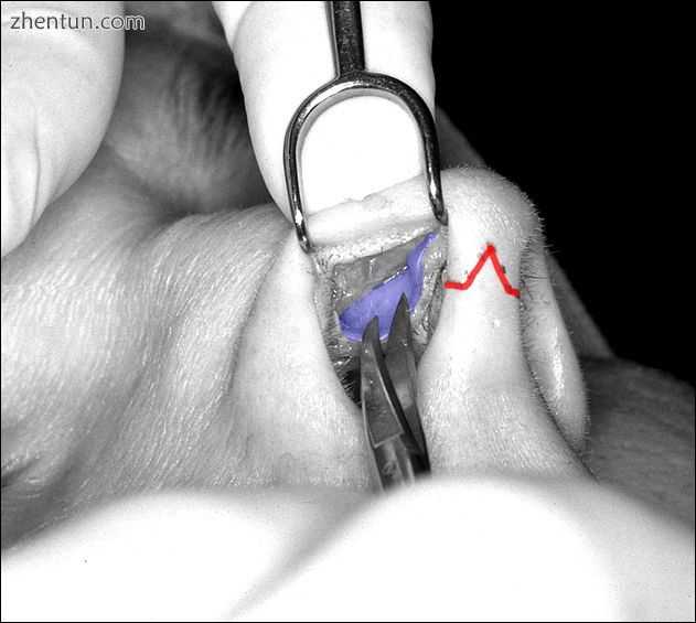 Photograph 2. Open rhinoplasty  The right lower lateral cartilage (blue) is expo.jpg