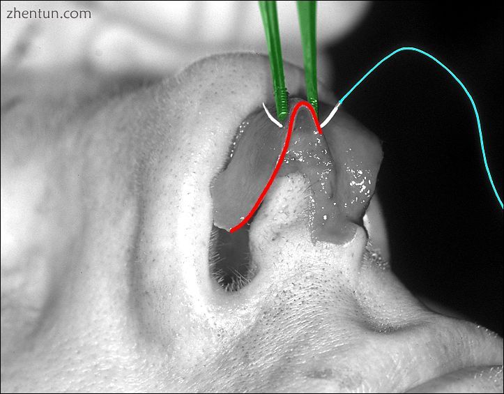 Photograph 3. Open rhinoplasty the nasal tip is sutured to narrow the nose..jpg