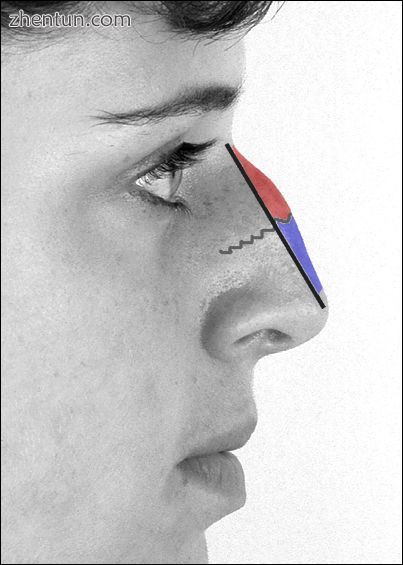 Photograph 4. Rhinoplastic correction A nasal-hump excision plan the black line .jpg