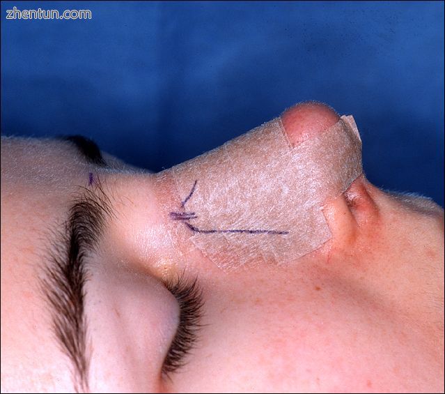 Photograph B. Open rhinoplasty.jpg