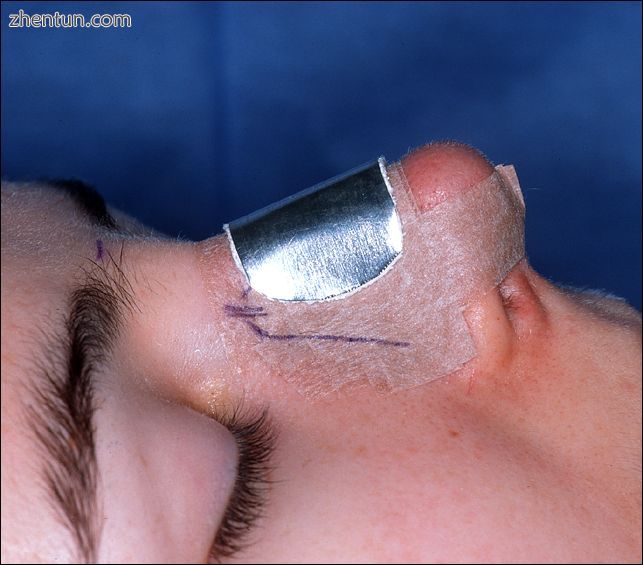 Photograph C. Open rhinoplasty.jpg