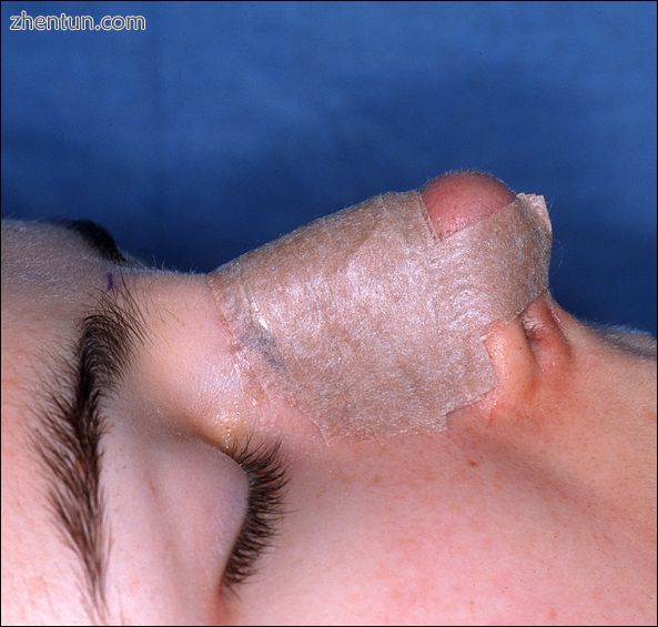 Photograph D. Open rhinoplasty.jpg