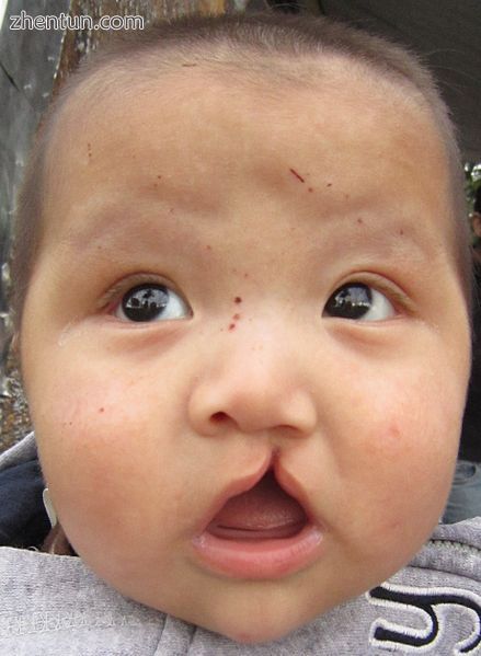 Rhinoplastic correction  A child afflicted with a cleft lip and a cleft palate..JPG