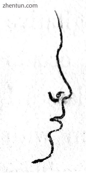Rhinoplasty  Nasal Class V. The Snub nose. (Nasology Eden Warwick, 1848).jpg