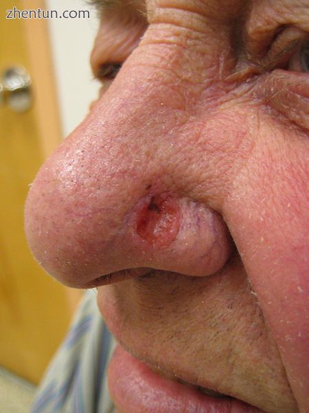 Rhinoplasty A basal-cell carcinoma lesion on the juncture of the left alar base .jpg