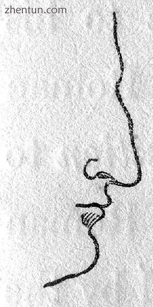 Rhinoplasty Nasal Class I. The Roman nose. (Nasology Eden Warwick, 1848).jpg