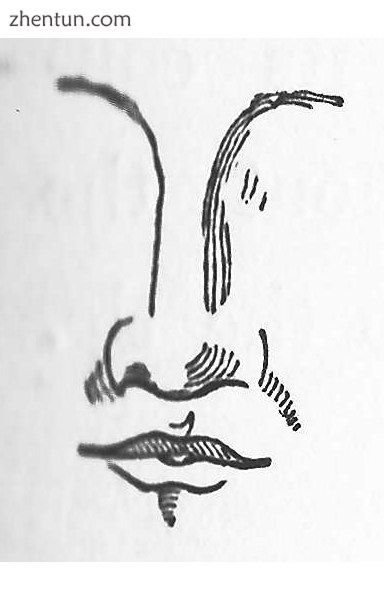 Rhinoplasty Nasal Class III. The African nose. (Nasology Eden Warwick, 1848).jpg